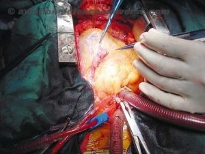 Open Heart surgery 